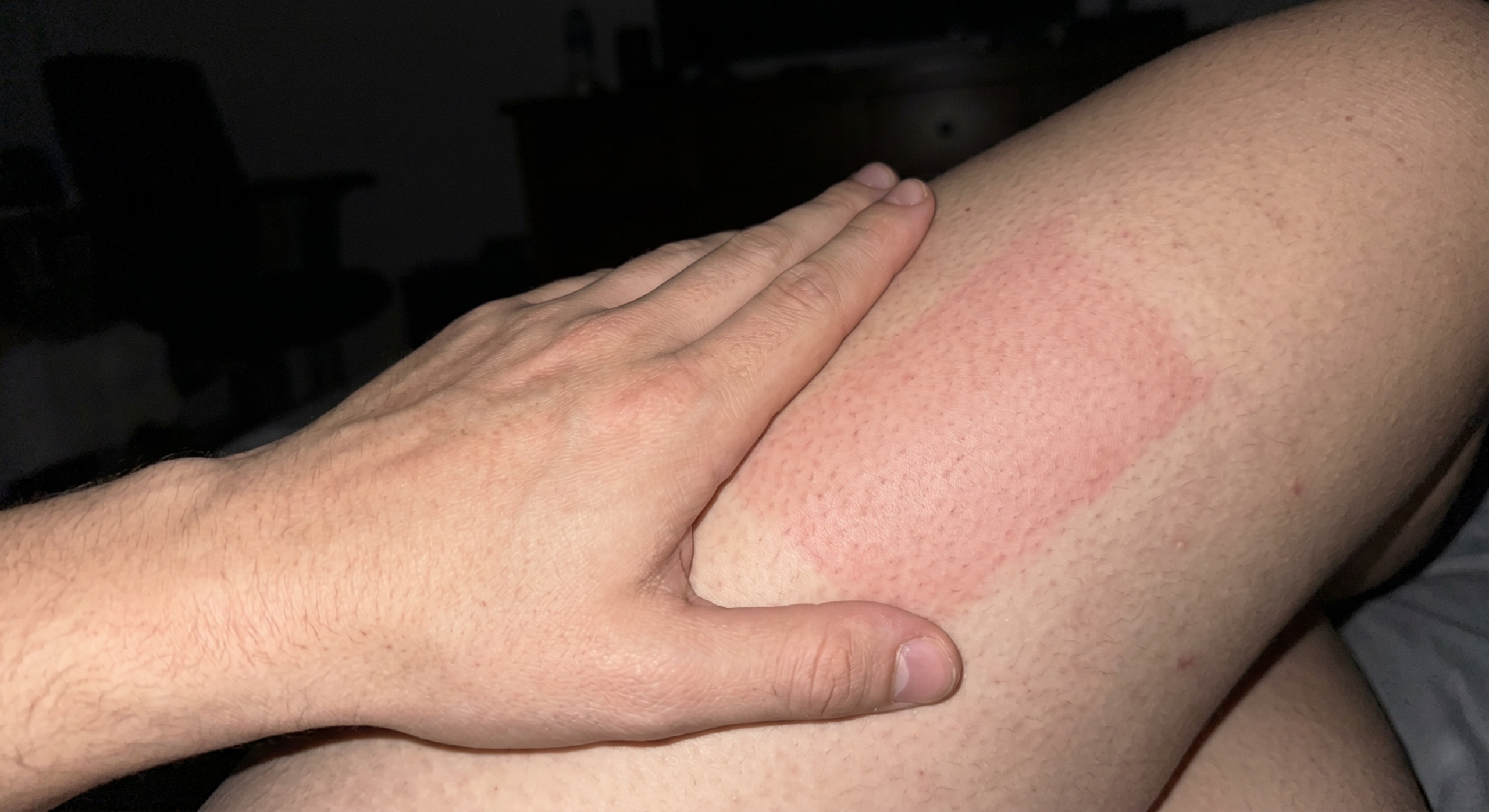 close-up-iphone-photo-of-hand-on-thigh-with-red-impact-mark